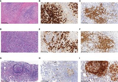 Tumor Flare Reaction in a Classic Hodgkin Lymphoma Patient Treated With Brentuximab Vedotin and Tislelizumab: A Case Report